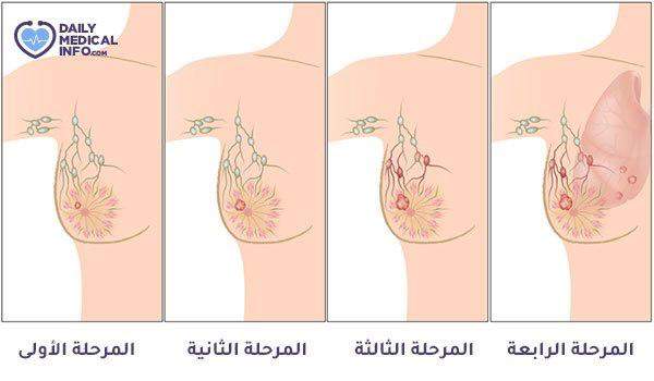 أبرز علامات سرطان الثدي الواجب عليكِ معرفتها!
