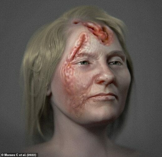مرض الزهري.. دمر وجه امرأة آيسلندية قبل 500 عام